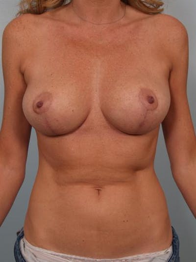 Breast Reduction Before & After Gallery - Patient 1310432 - Image 2