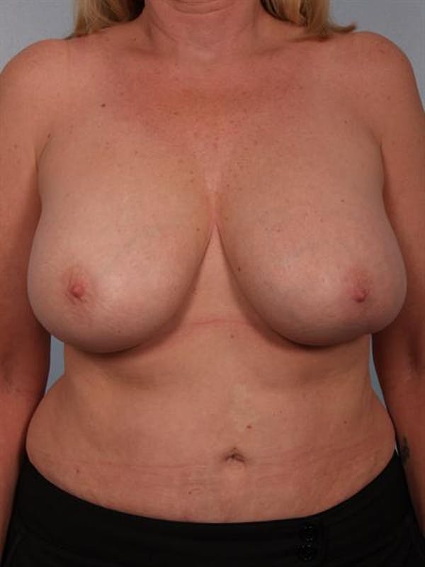 Breast Lift Gallery - Patient 1310433 - Image 1