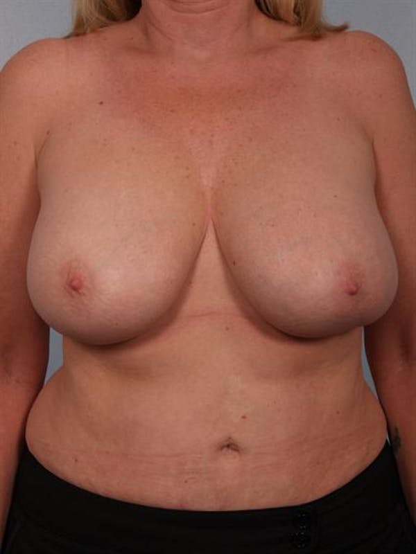 Breast Lift Before & After Gallery - Patient 1310433 - Image 1