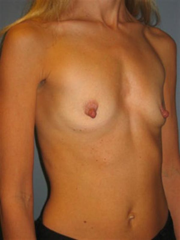 Nipple/Areolar Surgery Before & After Gallery - Patient 1310435 - Image 7
