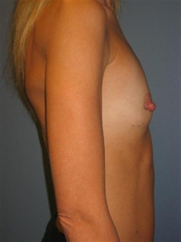 Nipple/Areolar Surgery Before & After Gallery - Patient 1310435 - Image 9