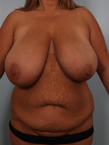 Before image of Breast Reduction in Beverly Hills by Dr. Cohen.