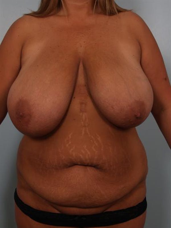 Breast Reduction Gallery - Patient 1310436 - Image 1