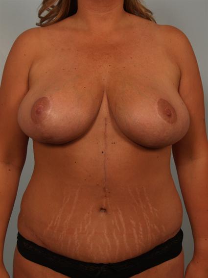 after image of Breast Reduction in Beverly Hills by Dr. Cohen.