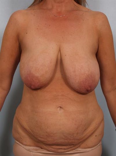 Breast Lift Before & After Gallery - Patient 1310437 - Image 1