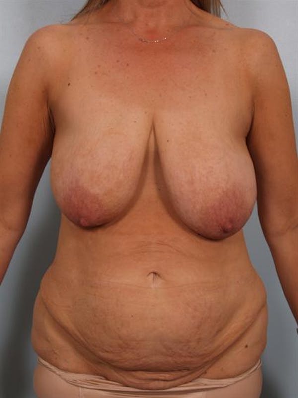 Breast Lift Gallery - Patient 1310437 - Image 1