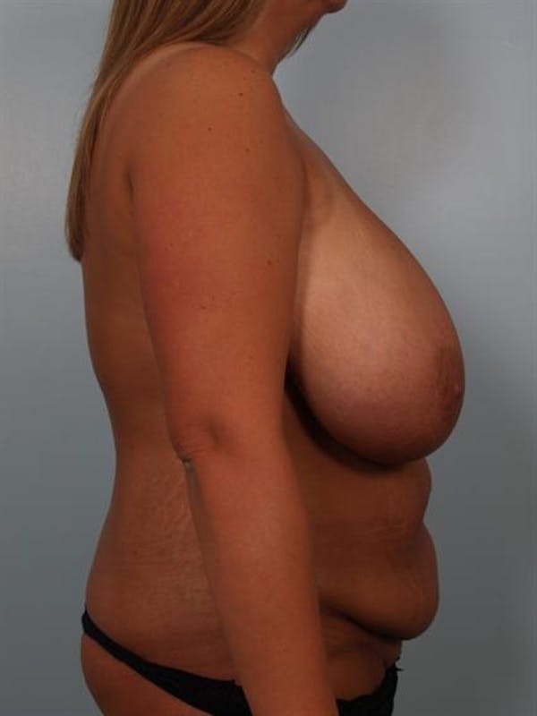 Breast Reduction Before & After Gallery - Patient 1310436 - Image 5