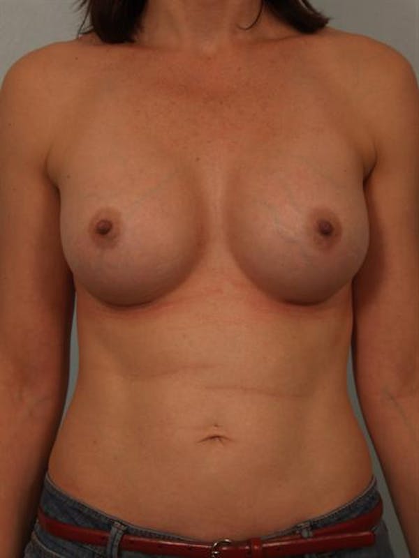 Nipple/Areolar Surgery Before & After Gallery - Patient 1310438 - Image 2