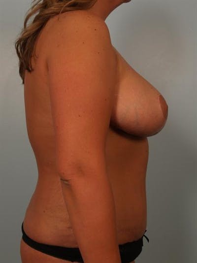 Breast Reduction Before & After Gallery - Patient 1310436 - Image 6