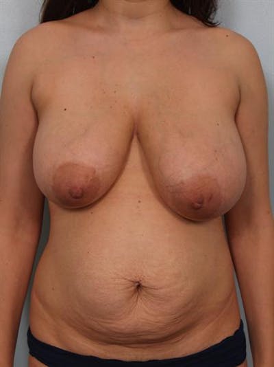 Breast Reduction Before & After Gallery - Patient 1310441 - Image 1