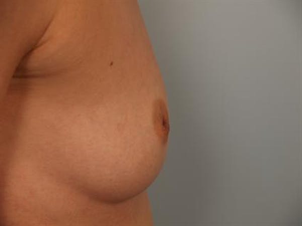 Nipple/Areolar Surgery Before & After Gallery - Patient 1310438 - Image 5