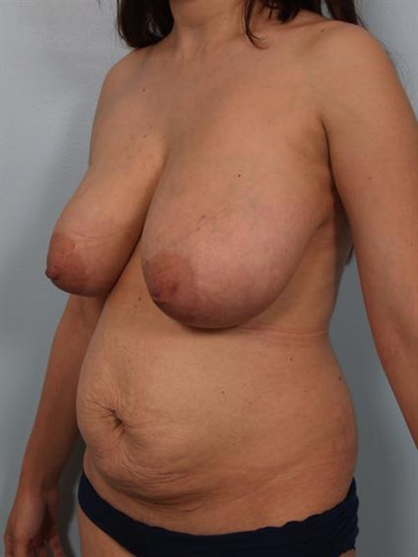 Breast Reduction Gallery - Patient 1310441 - Image 3