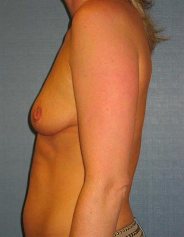 Nipple/Areolar Surgery Before & After Gallery - Patient 1310443 - Image 3