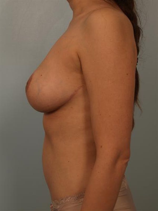 Breast Reduction Gallery - Patient 1310441 - Image 6