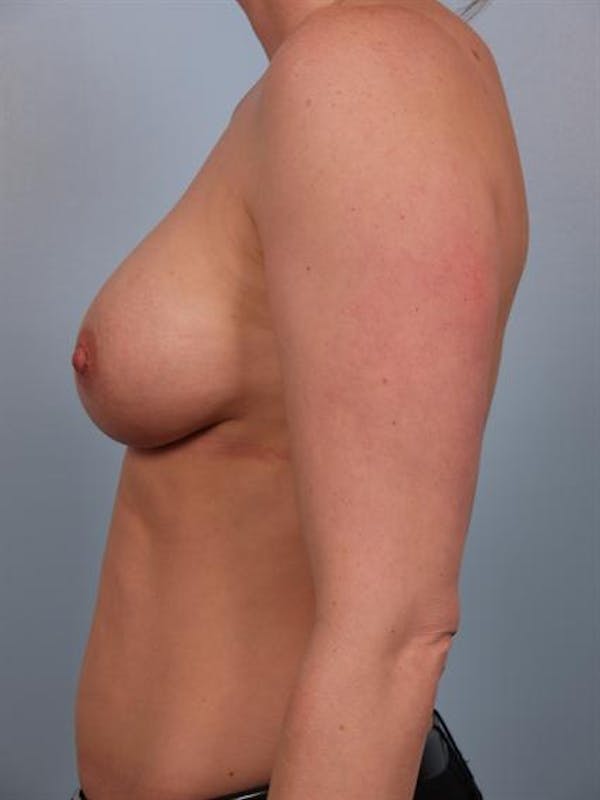 Nipple/Areolar Surgery Before & After Gallery - Patient 1310443 - Image 4