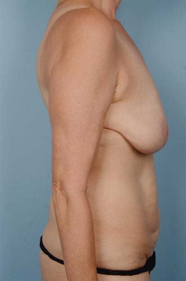 Breast Lift Before & After Gallery - Patient 1310442 - Image 5