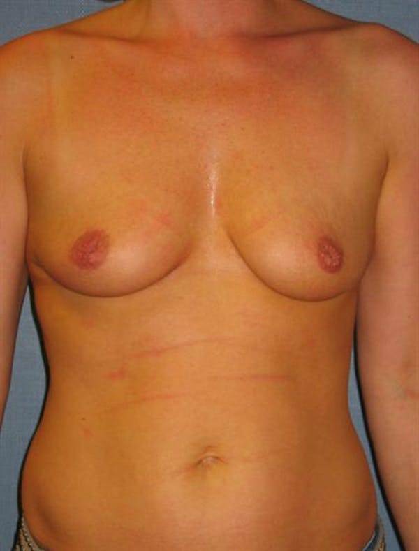 Nipple/Areolar Surgery Before & After Gallery - Patient 1310443 - Image 5