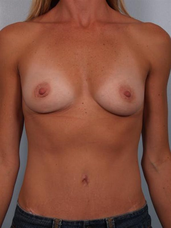 Breast Augmentation Before & After Gallery - Patient 1310444 - Image 3