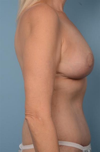 Breast Lift Before & After Gallery - Patient 1310442 - Image 6