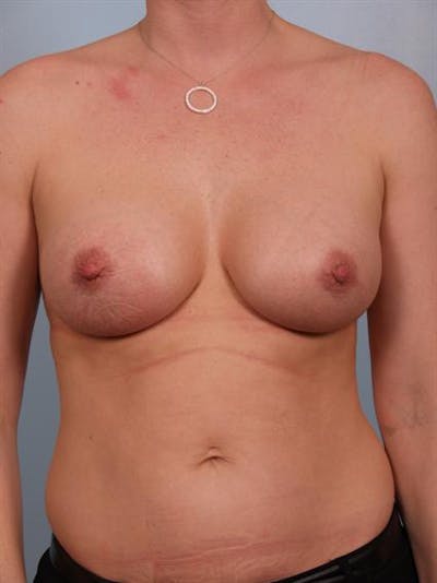 Nipple/Areolar Surgery Before & After Gallery - Patient 1310443 - Image 6