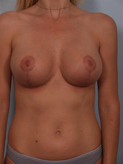 Breast Lift Before & After Gallery - Patient 1310446 - Image 2