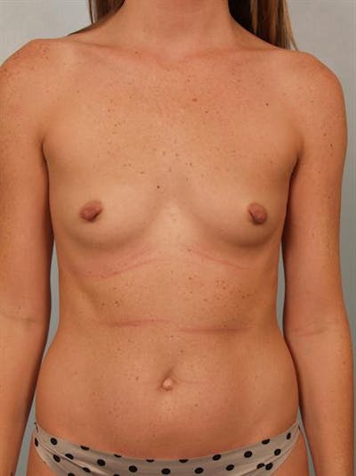 Nipple/Areolar Surgery Gallery - Patient 1310447 - Image 1