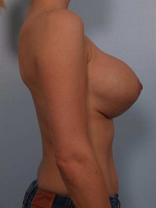 Breast Lift Before & After Gallery - Patient 1310446 - Image 3