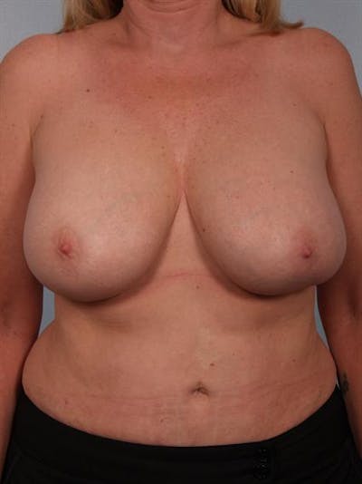 Breast Reduction Before & After Gallery - Patient 1310448 - Image 1