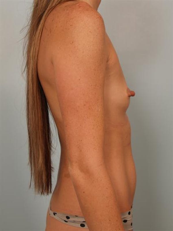 Nipple/Areolar Surgery Before & After Gallery - Patient 1310447 - Image 5