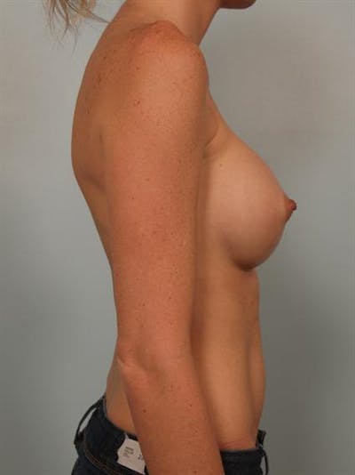 Nipple/Areolar Surgery Before & After Gallery - Patient 1310447 - Image 6