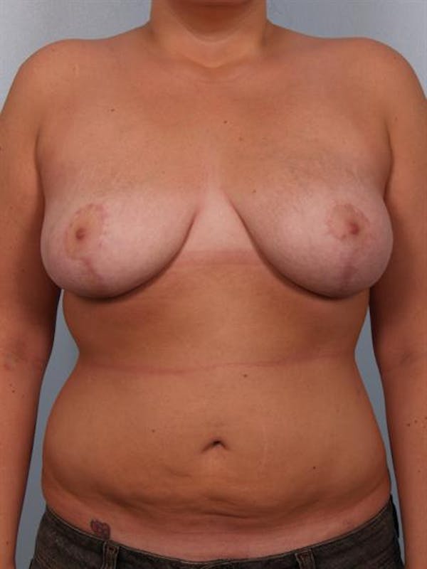 Breast Lift Before & After Gallery - Patient 1310453 - Image 2