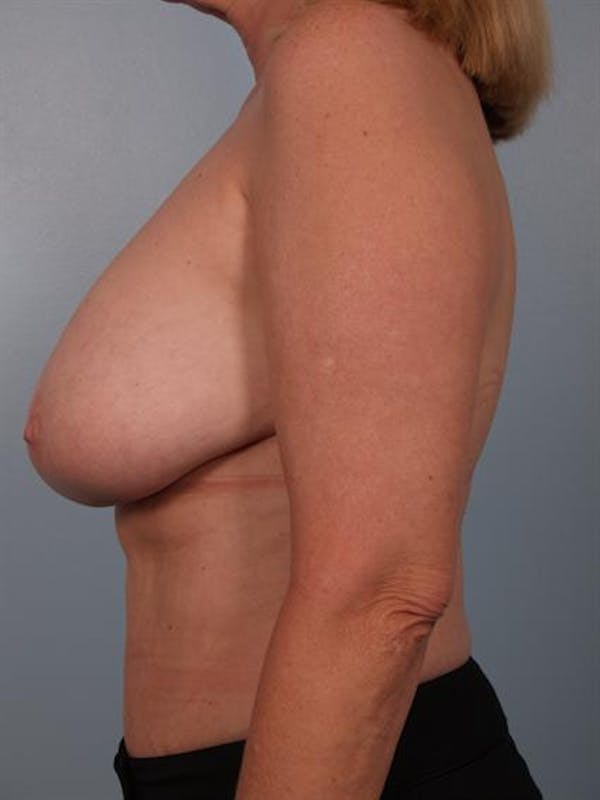 Breast Reduction Before & After Gallery - Patient 1310448 - Image 5
