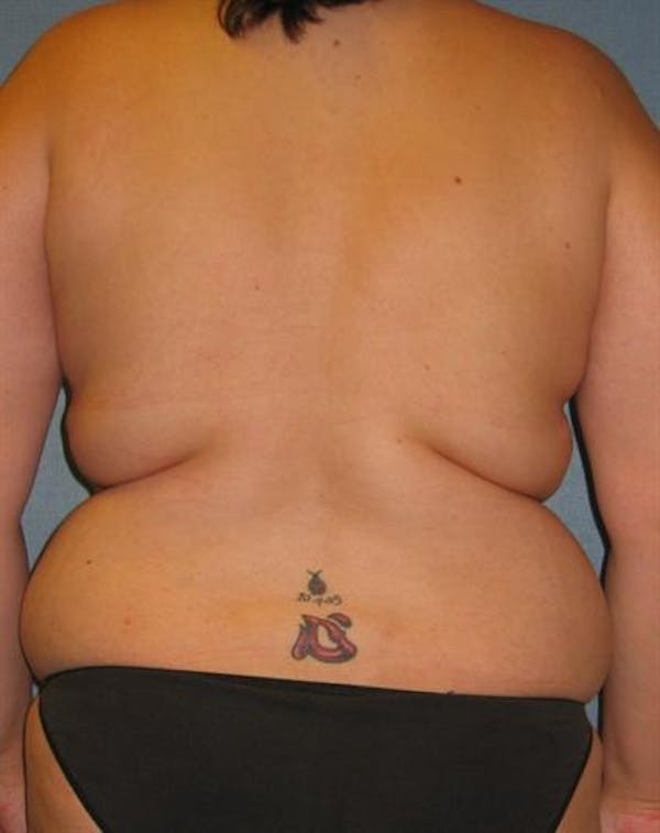 Breast Lift Gallery - Patient 1310453 - Image 5