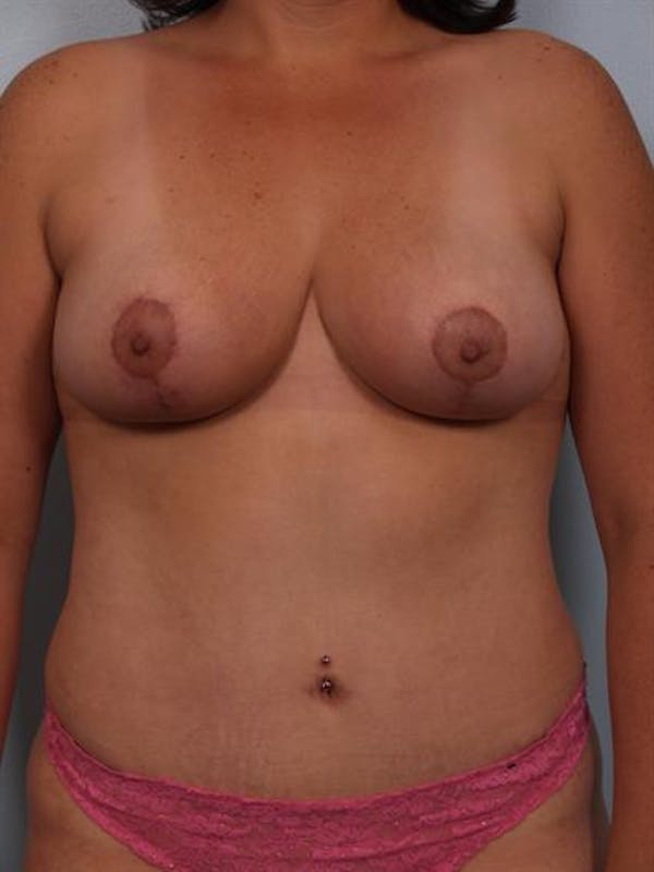 Breast Reduction Before & After Gallery - Patient 1310454 - Image 2