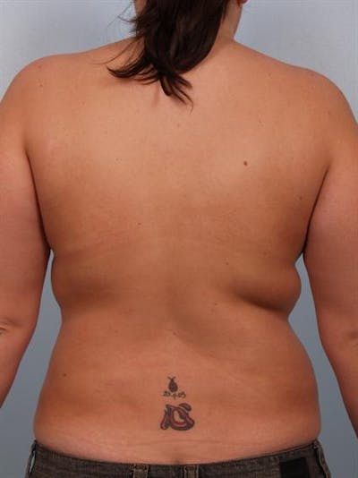 Breast Lift Before & After Gallery - Patient 1310453 - Image 6