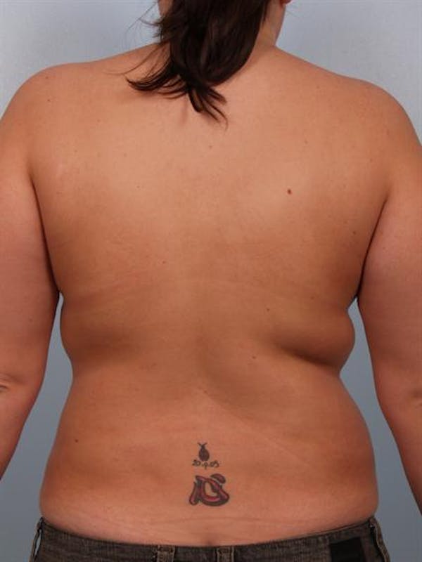 Breast Lift Gallery - Patient 1310453 - Image 6