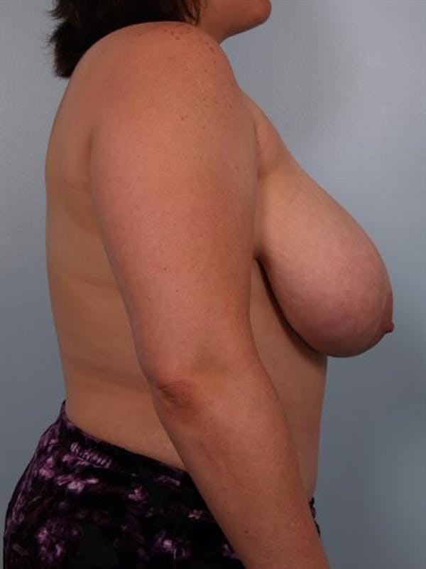 Breast Reduction Before & After Gallery - Patient 1310454 - Image 5