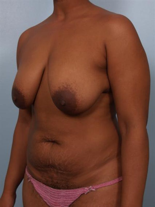 Breast Reduction Before & After Gallery - Patient 1310458 - Image 3