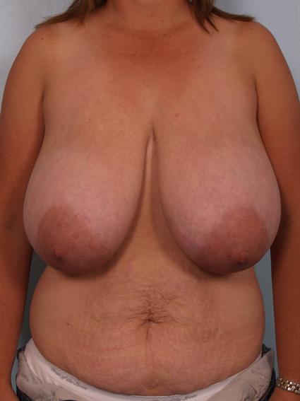 Before image of Breast Reduction in Beverly Hills by Dr. Cohen.