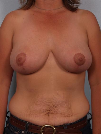 after image of Breast Reduction in Beverly Hills by Dr. Cohen.
