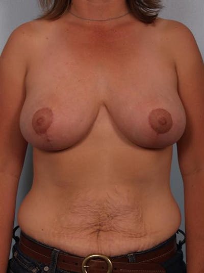 Breast Reduction Before & After Gallery - Patient 1310462 - Image 2