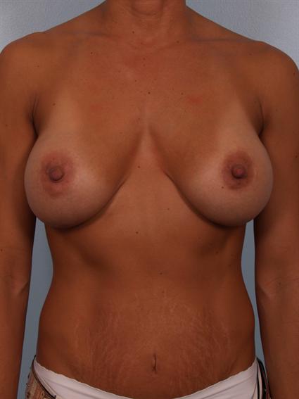 Before image of Breast Revision in Beverly Hills by Dr. Cohen.