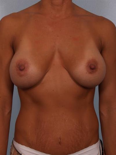 Complex Breast Revision Before & After Gallery - Patient 1310463 - Image 1