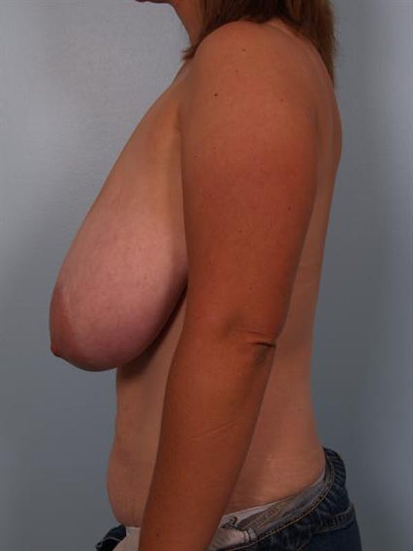 Breast Reduction Before & After Gallery - Patient 1310462 - Image 5
