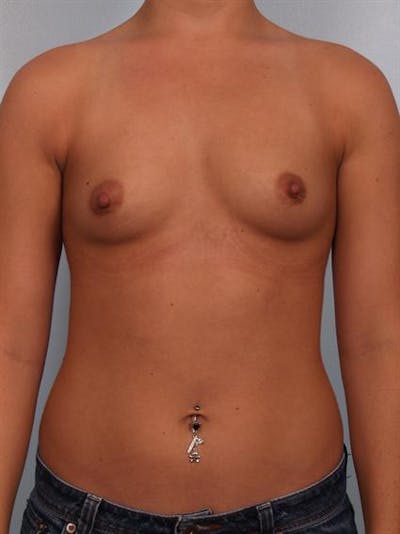 Breast Augmentation Before & After Gallery - Patient 1310465 - Image 1