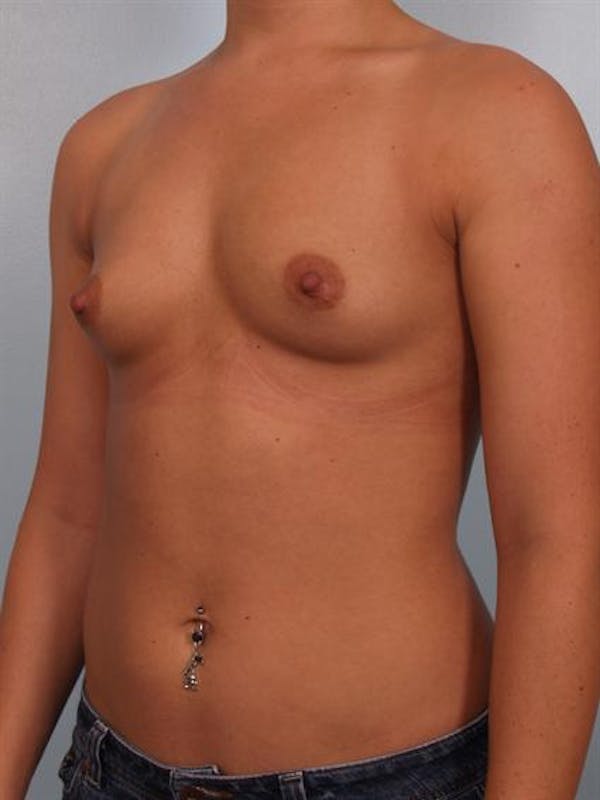 Breast Augmentation Before & After Gallery - Patient 1310465 - Image 3