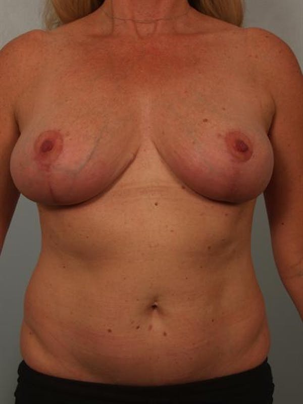 Breast Reduction Before & After Gallery - Patient 1310466 - Image 2