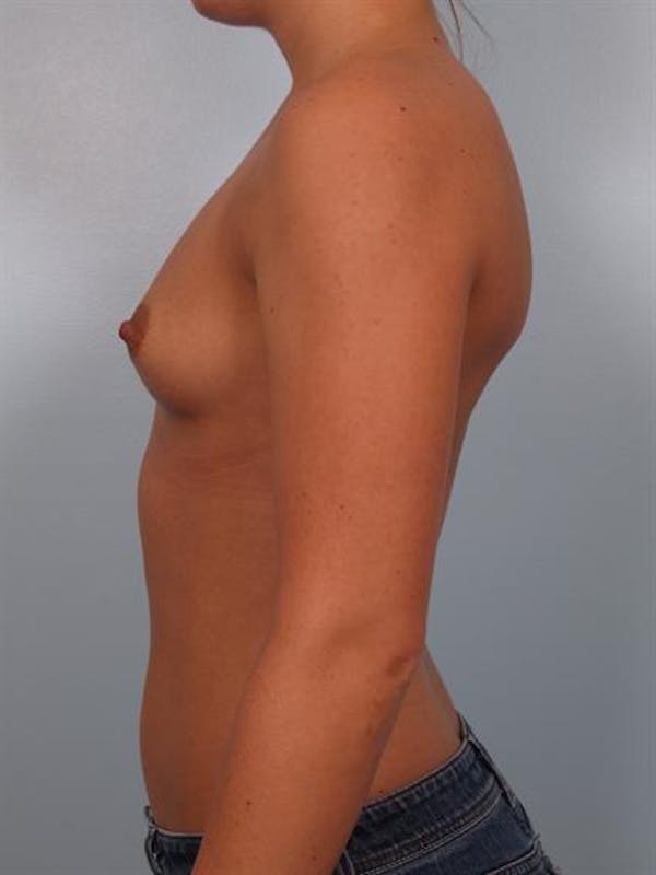 Breast Augmentation Gallery - Patient 1310465 - Image 5