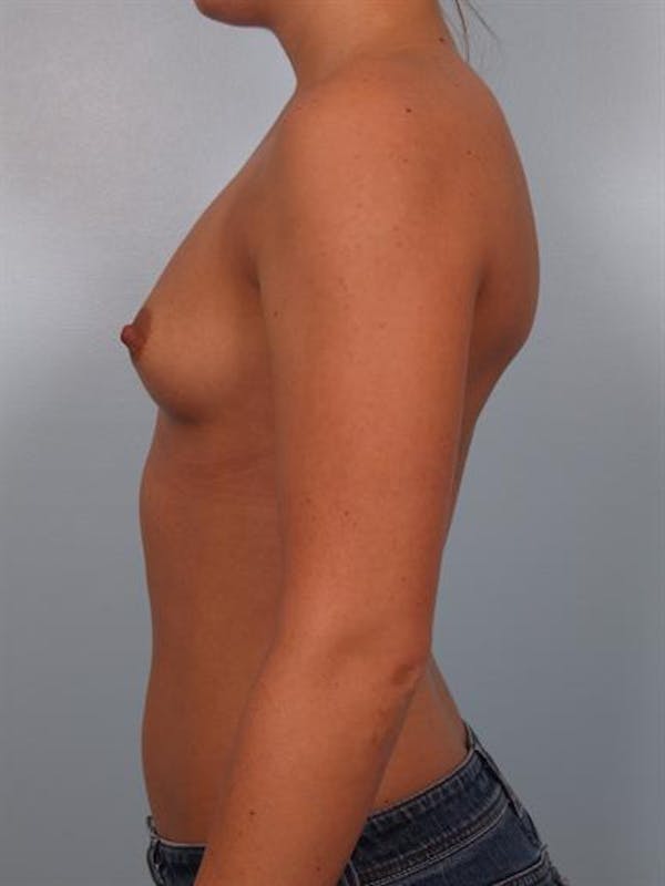 Breast Augmentation Before & After Gallery - Patient 1310465 - Image 5