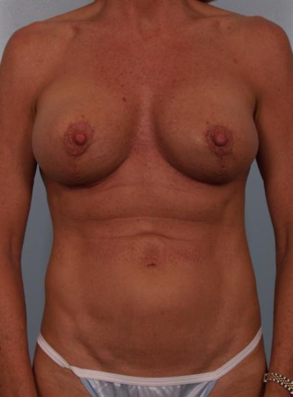 Complex Breast Revision Before & After Gallery - Patient 1310467 - Image 2